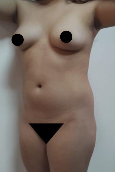 Antes-01