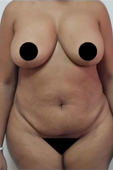 Antes-33