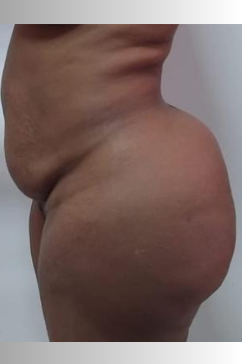 Antes-44